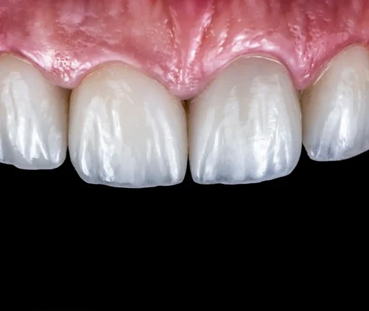 Esteticaa dentara -fatete dentare home dental clinics